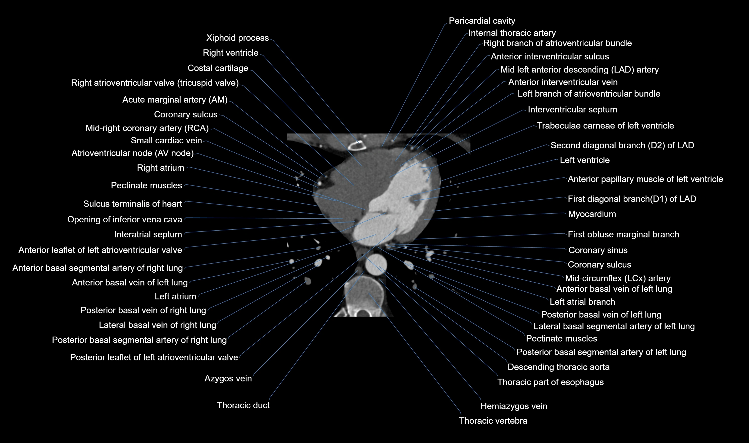 CT heart (coronary angiogram) axial view cross sectional anatomy labelled radiology image-00043.webp